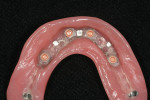 The tissue side of the processed
denture showing Equator attachments.