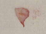 Figure 3  Distal wedge tissue removed.