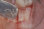 Figure 7  Clinical image of trap door surgical incisions.