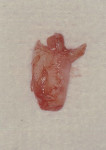 Figure 8  Connective tissue removed with TD surgical procedure.