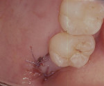 Figure 11  Suturing of distal surface of trap door.