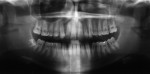 Figure 1  (Case 1) Preoperative panoramic radiograph taken for orthodontic records in 2003. Note distal root of the mandibular left first molar.
