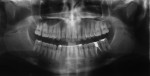 Figure 8  (Case 1) Panoramic radiograph taken in 2010. Note PARR of mandibular anteriors from orthodontic therapy and LIAR of mandibular left and mandibular right first molars.
