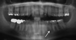 Figure 9  (Case 2) Panoramic radiograph taken in 2005. Note PARR of mandibular left second premolar.
