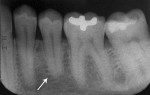 Figure 10  (Case 2) Periapical radiograph of mandibular left second premolar taken in 2009.