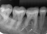 Figure 12  (Case 3) Periapical radiographs taken in 2007. Note PARR of both mesial and distal roots greater on the mandibular right first molar (Fig 12) than the mandibular left first molar (Fig 13).