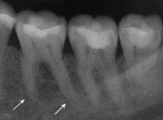 Figure 13  (Case 3) Periapical radiographs taken in 2007. Note PARR of both mesial and distal roots greater on the mandibular right first molar (Fig 12) than the mandibular left first molar (Fig 13).