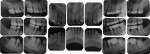 Figure 15  (Case 4) Full-mouth series of radiographs taken in 2005.