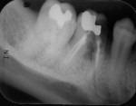 Figure 16  (Case 4) Close-up of mandibular right second premolar. Note fully developed root of the mandibular right second premolar.