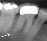 Figure 20  (Case 5) Periapical radiographs from 2010. Note PARR of the distal roots of the mandibular right (Fig 20) and mandibular left (Fig 21) first molars.