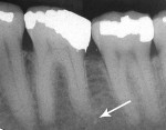 Figure 21  (Case 5) Periapical radiographs from 2010. Note PARR of the distal roots of the mandibular right (Fig 20) and mandibular left (Fig 21) first molars.