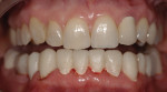Figure 4. The provisional restorations increased the vertical dimension of occlusion, creating an ideal plane of occlusion, and they restored
the beauty and symmetry of the mandibular anterior teeth.