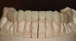 Figure 7. The facial view of the finished FCZ crowns on the master cast showing the natural proportions of the finished restorations.