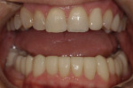 Figure 10. Final restorations shown in the mouth. Of note are the natural proportions,
the ideal occlusal scheme, and the health of the soft tissue.