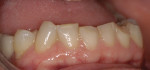 Figure 3. Close-up of loss of tooth structure.