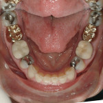 Figure 4. Structural compromises were present on all maxillary (Fig 3) and mandibular (Fig 4) posterior teeth due to large amalgam restorations or existing full-coverage crowns.