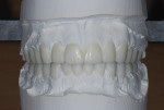 Figure 8. Wax-up done near the completion of orthodontics showed how the teeth would be restored to a more favorable relationship.