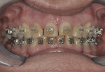 Figure 7. Orthodontic positioning enabled optimal restorative dentistry.