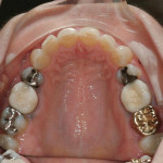 Figure 3. Structural compromises were present on all maxillary (Fig 3) and mandibular (Fig 4) posterior teeth due to large amalgam restorations or existing full-coverage crowns.