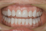 Figure 12. After cementation of all restorations, the patient’s biomechanical and functional risks were decreased.