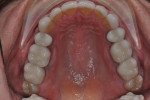 Figure 10. Upper arch after treatment
completion.
