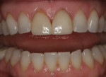 Figure 1. Preoperative frontal view displaying gingival recession, shade inconsistency, and incisal length disparity.