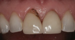 Figure 4. Diode laser used to change the gingival contour on the mesial aspect of the upper right maxillary incisor.