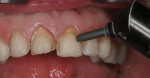 Figure 9. After removal of the provisional restorations, the prepared tooth surfaces were cleansed with
light air abrasion.