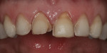 Figure 8. The prepared anterior teeth prior to placement of the provisional restorations.