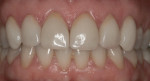 Figure 16. Frontal view of the final restorations in place in centric occlusion.