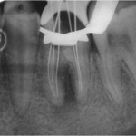 Figure 2  Working-length radiograph showing the presence of a wide mesiobuccal canal with a rather pronounced curvature.