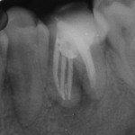 Figure 4  Post-obturation radiograph showing radiopacity between the middle mesial and mesiolingual canal, suggesting an isthmus.