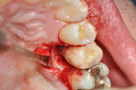 Figure 4. The circumferential osseous defect could be seen on the palatal aspect of No. 13 as well.