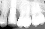 Figure 1. Patient presented with radiographic bone loss surrounding No. 13 implant.