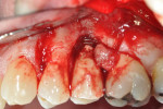 Figure 3. Surgical exposure of No. 13 site revealed a circumferential and buccal combined osseous defect. Note the excess cement present on the buccal of the implant–crown interface.