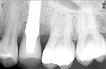 Figure 10. Radiograph taken immediately postoperatively showing minimal resection of interproximal peaks of bone and grafting materials in place.