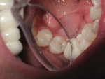 (Figure 5.) Microorganisms contribute to the localized chemical dissolution of the dental structure.