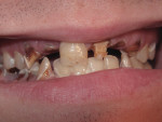 (Figure 7.) The caries process can run rampant and eventually destroy the dentition.