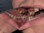 (Figure 8.) The caries process can run rampant and eventually destroy the dentition.