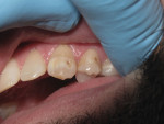 (Figure 4.) Microorganisms contribute to the localized chemical dissolution of the dental structure.