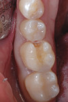 (Figure 2.) Preparation of tooth No. 30 for a composite restoration.