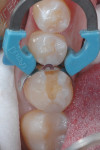 (Figure 4.) The Palodent Plus matrix was placed.