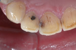 (Figure 8.) Preoperative appearance of the carious lesion on tooth No. 8 (lingual view).