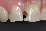 (Figure 9.) Frontal view after caries excavation.