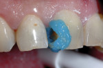 (Figure 11.) Etchant placed on the enamel surfaces.