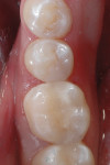 (Figure 6.) The final restoration of tooth No. 30.