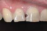 (Figure 7.) Preoperative appearance of a carious lesion on tooth No. 8 (frontal view).