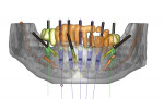 (Figure 1.) Image of a patient’s plan who is scheduled to have remaining mandibular anterior teeth extracted, alveolectomy, alveoplasty, implant placement, and immediate restoration. All planning can be simulated, including implant positioning relative to the mandibular nerve, osseous reduction, surgical guide fabrication, and provisional restoration. (Reprinted by permission. Mandelaris GA, et al. Computer-guided implant dentistry for precise implant placement. Int J Periodontics Restorative Dent. 2010;30(3):275-281.)