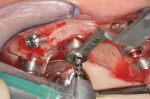 (Figure 2.) Tissue-supported full-arch computer-generated surgical guide fixated with transverse pins showing drill, drilling tube, and reduction sleeve.