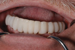 (Figure 6.) Provisional denture.